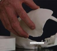 Brasileiros desenvolvem tecnologia de reconstrução craniana