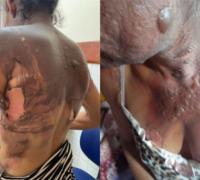 Ipiaú: Mulher sofre queimaduras após companheiro jogar água fervente nela