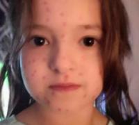 Garotinha de 6 anos desenha catapora no próprio corpo para não ter que ir a escola
