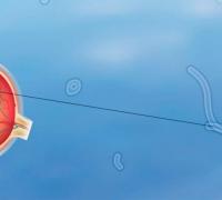 O que são moscas volantes?