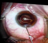 Cirurgia de Catarata