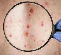 Prefeitura de Irecê comunica dois casos suspeitos de Varíola dos Macacos