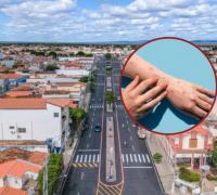 Homem que teve Varíola dos Macacos em Xique-Xique têm lesões curadas e sem risco de transmissão da doença