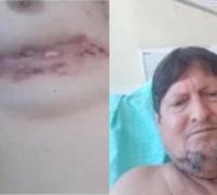 Com câncer na medula homem necessita de ajuda