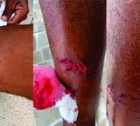 Cães voltam a atacar mais uma pessoa em Xique-Xique; é a terceira vítima em menos de 48 horas